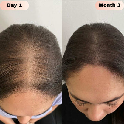 Revivra™ Advanced Hair Growth Roll-On Serum